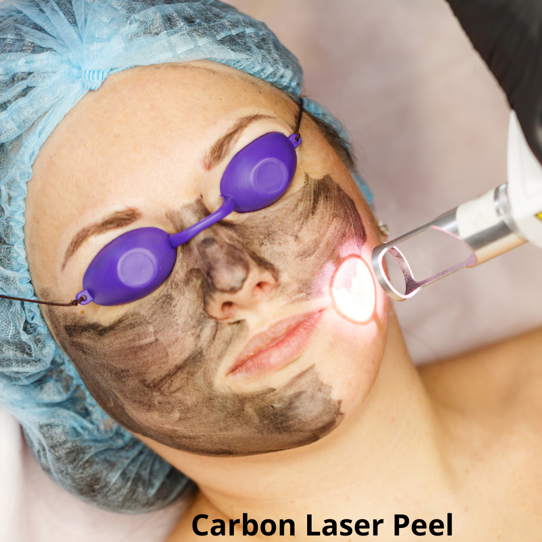 Carbon laser peeling